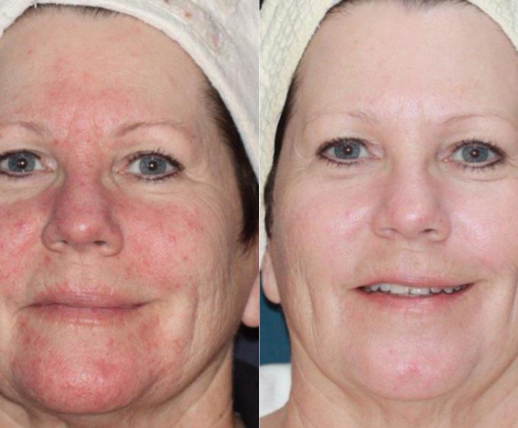 Rosé to Rosacea