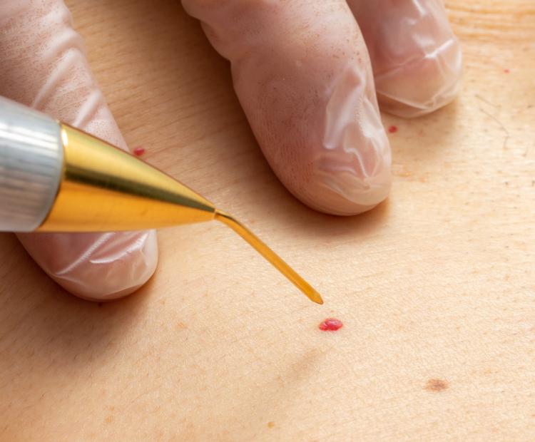 Cherry Angioma: Skin Lesion or Delicious Dessert?
