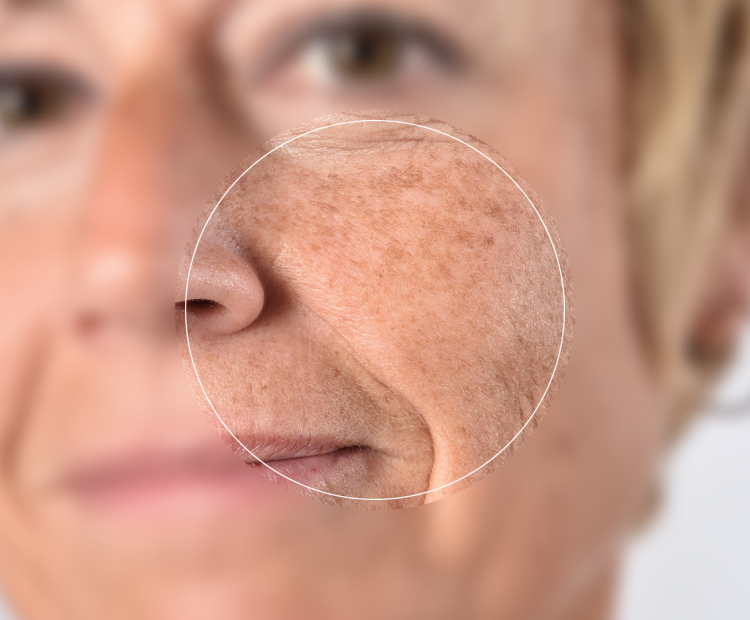Beals Skin and Laser Age Spots Scottsdale Skin care