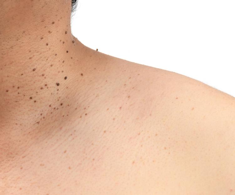 Seborrheic Keratosis