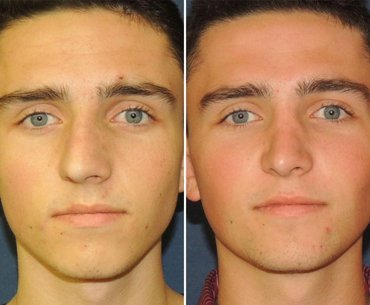 Male rhinoplasty patient